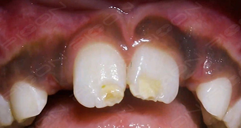 Laser-Assisted Surgical Exposure for Unerupted Lateral Incisor Management