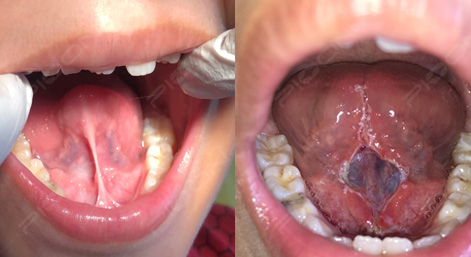 Management of Tongue-Tie/Ankyloglossia - A Surgical Procedure with Dental Laser