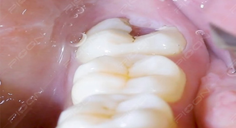 Management of Pericoronitis Using Dental Diode Laser