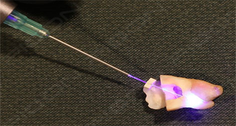 Root Canal Disinfection in Primary Molar During Pulpectomy Procedure using S1 PIOON LASER