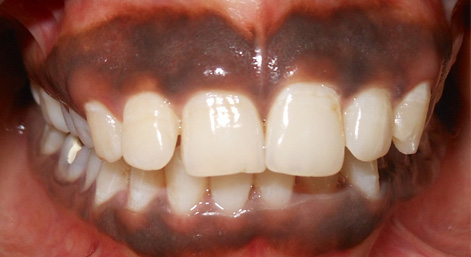 Gingival Depigmentation with Dental Lasers for Management of Gingival Hyperpigmentation