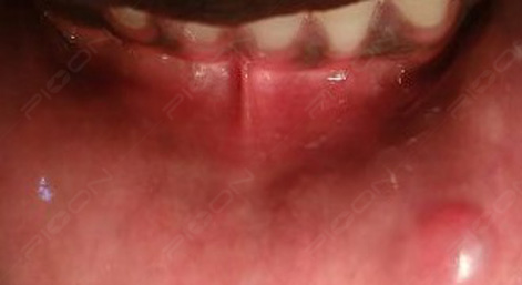 Excision of Fibroma using Dental Soft-tissue Diode Laser