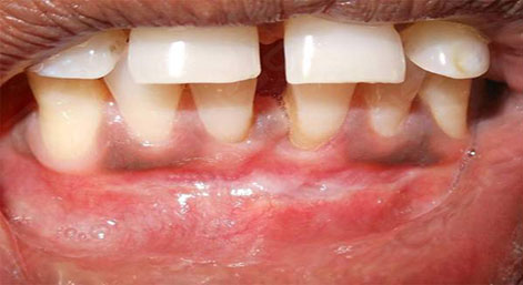 Vestibuloplasty Procedure using Dental Diode Lasers