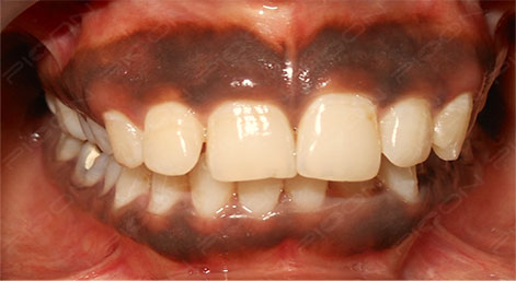 Treatment of Gingival Melanin Hyperpigmentation using Dental Diode Laser
