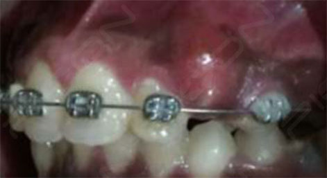Orthodontic Exposure of Impacted Permanent Tooth using Soft Tissue Diode Laser