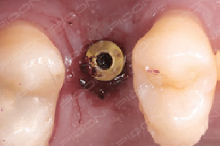 How do implant doctors use dental laser effectively?