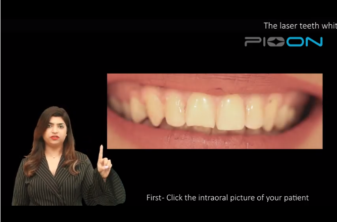 Teeth bleaching using S1 pioon laser