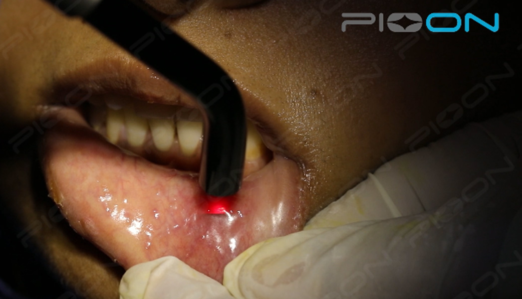 Applications of Low-Level laser therapy in dental practice