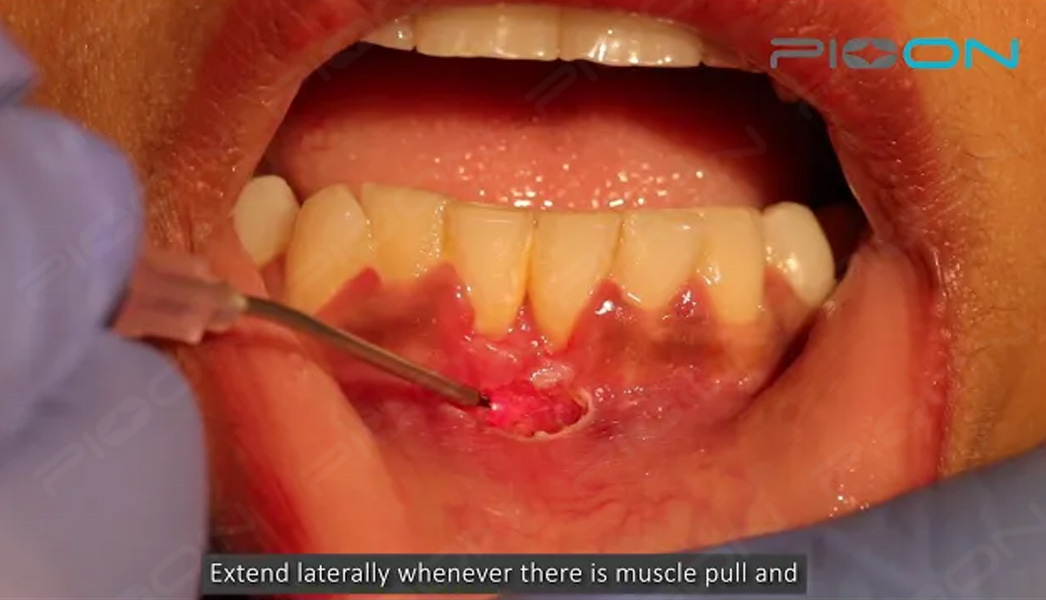 Procedure of Frenotomy using S1 Pioon laser