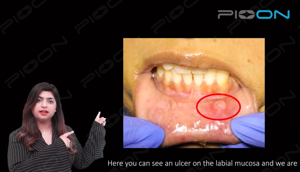LLLT(Photobiomodulation) for Aphthous ulcers using S1 Pioon Laser