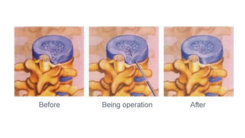 Basic Introduction of PLDD — Percutaneous Laser Disc Decompression