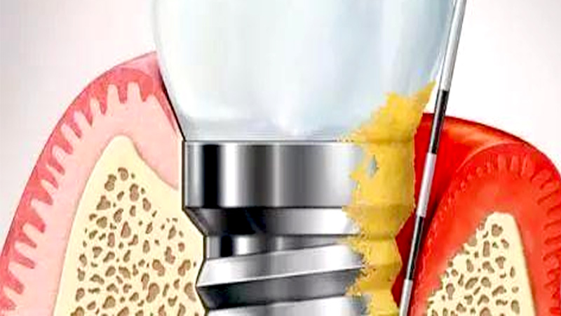 oral implants