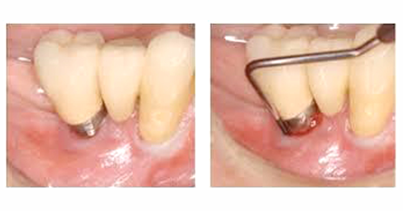 The classical Periodontal treatment protocol