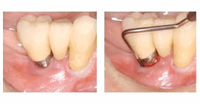 periodontitis