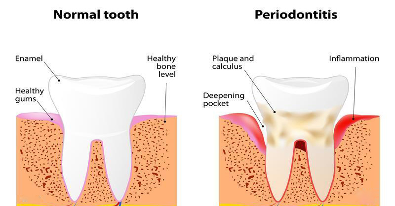 7 Benefits of Using Laser Therapy for Periodontal Disease