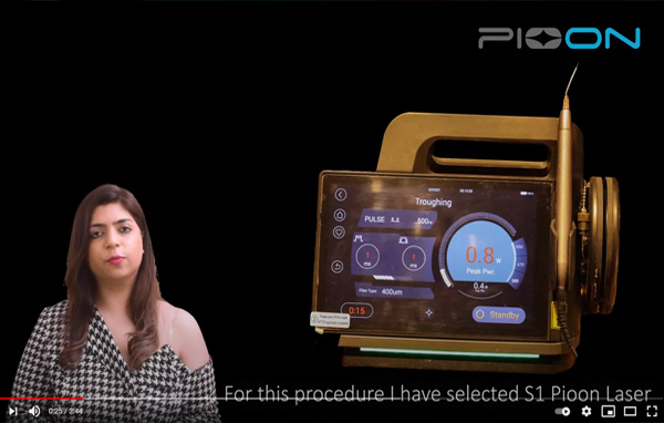 Frenectomy procedure using S1 Pioon laser in Padiatric patient