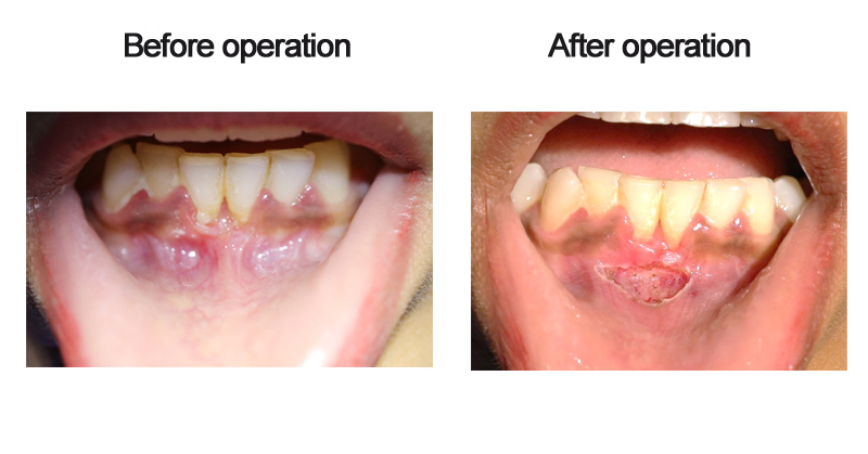 FRENOTOMY USING DIODE LASER