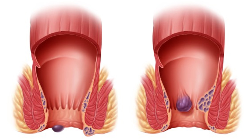 Medical Laser In Proctology