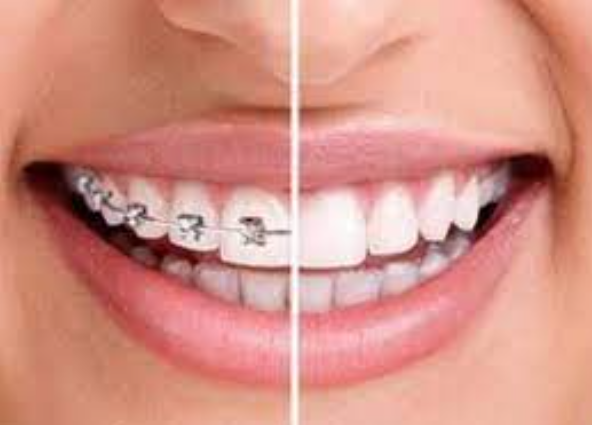 (LLLT)Low-level laser therapy in acclerating orthodontic tooth