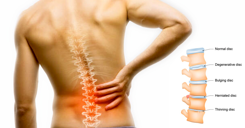 PLDD-Let your intervertebral disc no longer “protrude”