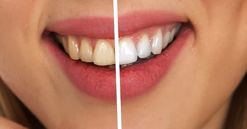 Comparison of Laser Teeth Whitening and LED Cold Light Bleaching