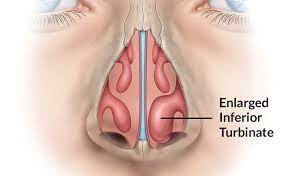 Diode Surgical Laser: Effective & Economical Treatment for Inferior Turbinate Hypertrophy