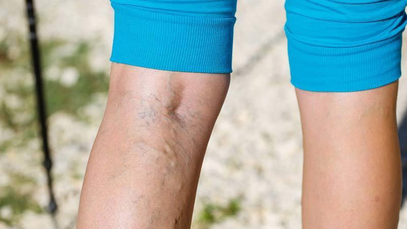 Intracavitary treatment of varicose veins