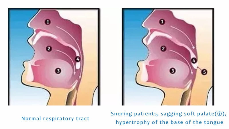 Diode laser-a revolutionary method to treat snoring