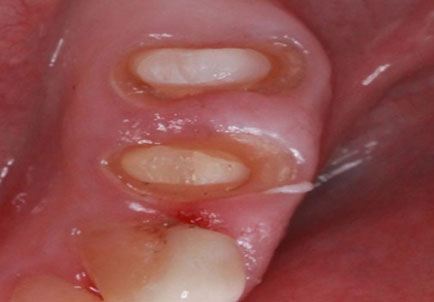 gingival troughing procedure