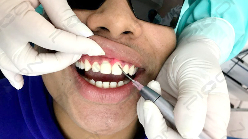 Advantages of dental laser in periodontitis