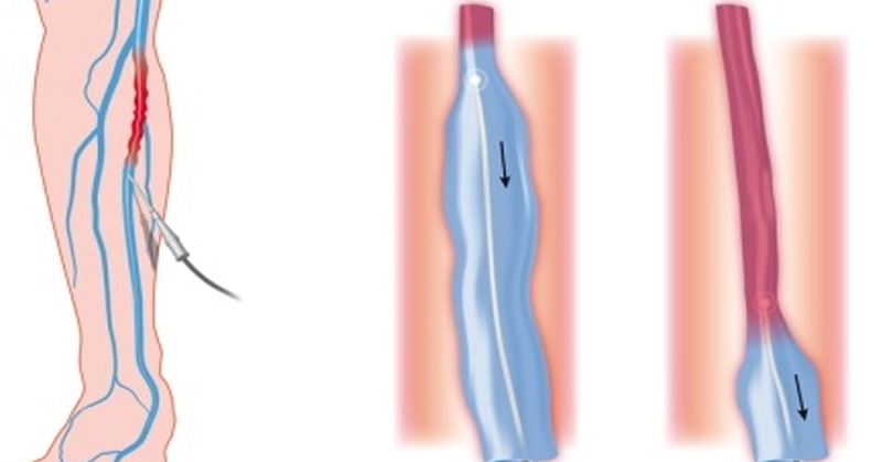 Endovenous Laser Ablation