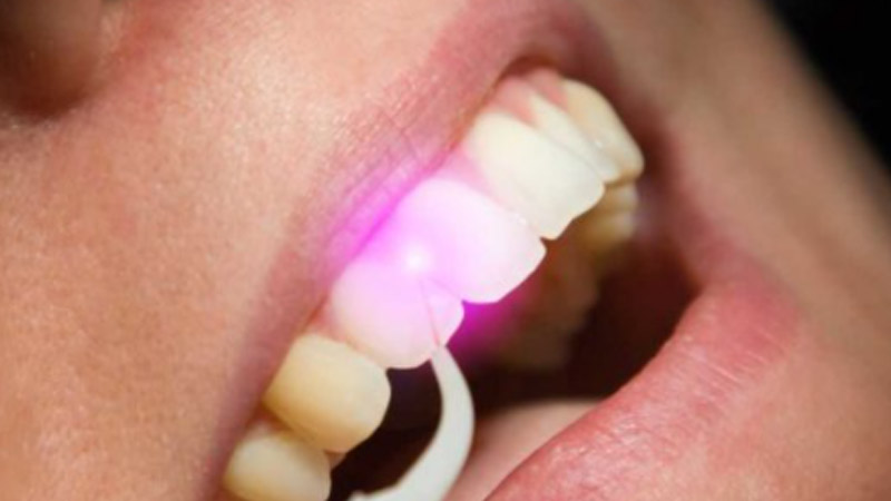 The Types of Lasers Used in Dentistry