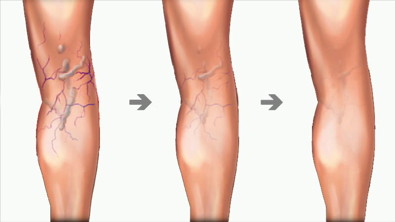 Laser 1470nm EVLT Endovenous Laser Ablation of Varicose Veins