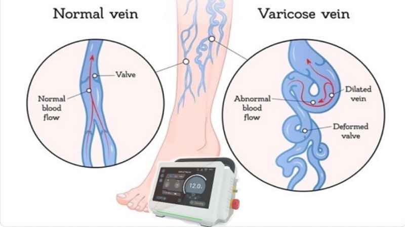 The Benefits of Laser Treatments for Varicose Veins