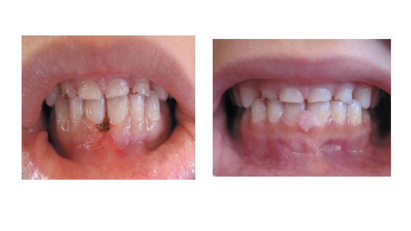Laser periodontal surgery