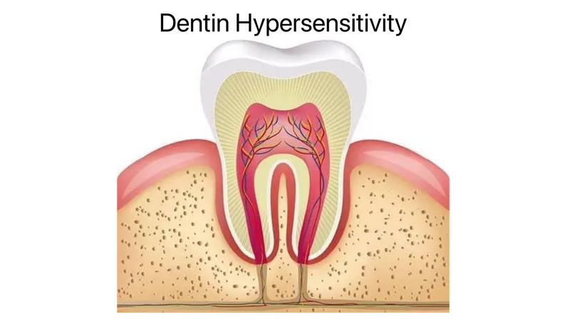 Treatment for Dentin Hypersensitivity using 980nm