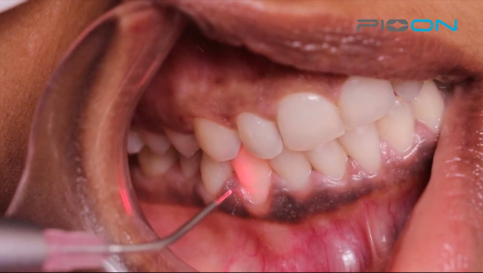 The most effective dentin desensitization method - Pioon Laser