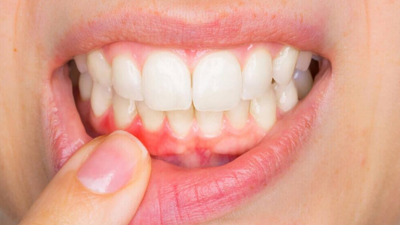 Laser gingival retraction