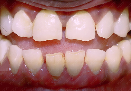 Management of Early Periodontitis using Lasers