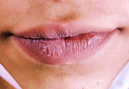 Lip hyperpigmentation 