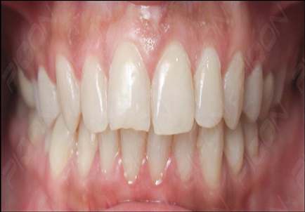 Discoloured teeth