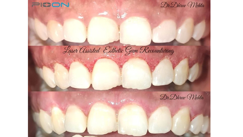 Laser assisted aesthetic gum recontouring