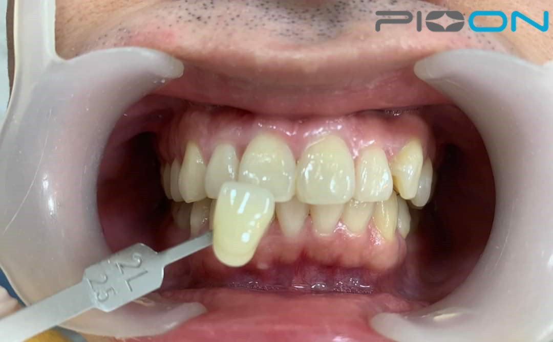 Pioon S3 dental laser PK 45 minutes of plasma whitening light.