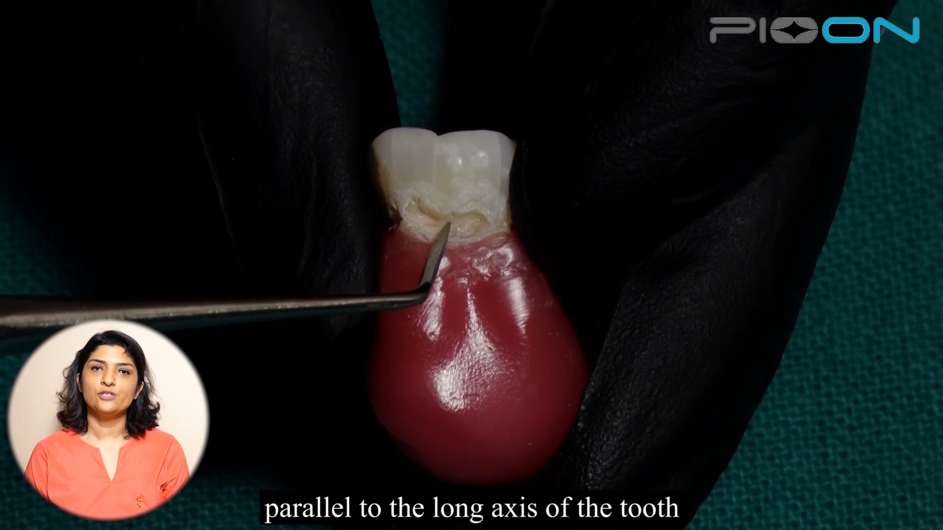 Prevent postoperative sensitivity after class Ⅴ restorations