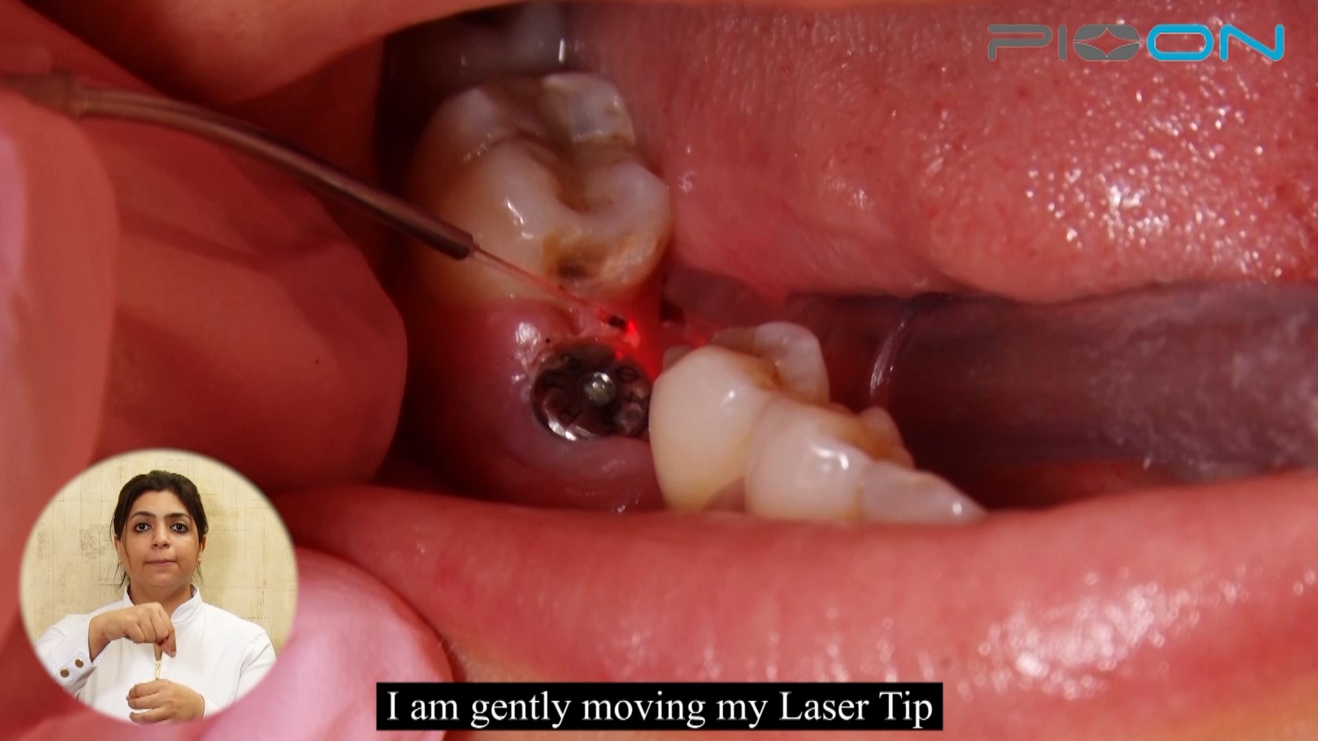 Recontouring of the gingiva around the implant