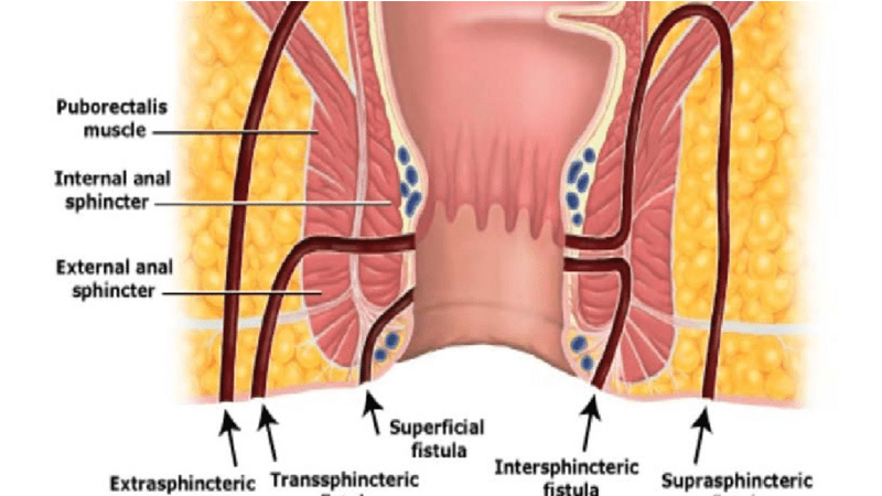 What are the best wavelength and accessory for anal fistula?