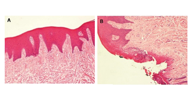 The Performance of 450nm Diode Laser in Oral Surgery Procedures. 