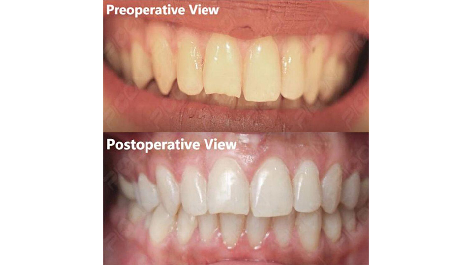 Benefits Of Laser Teeth Whitening