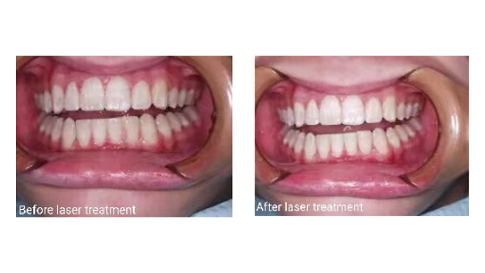 Applications of Pioon Diode Laser in Orthodontic Treatment