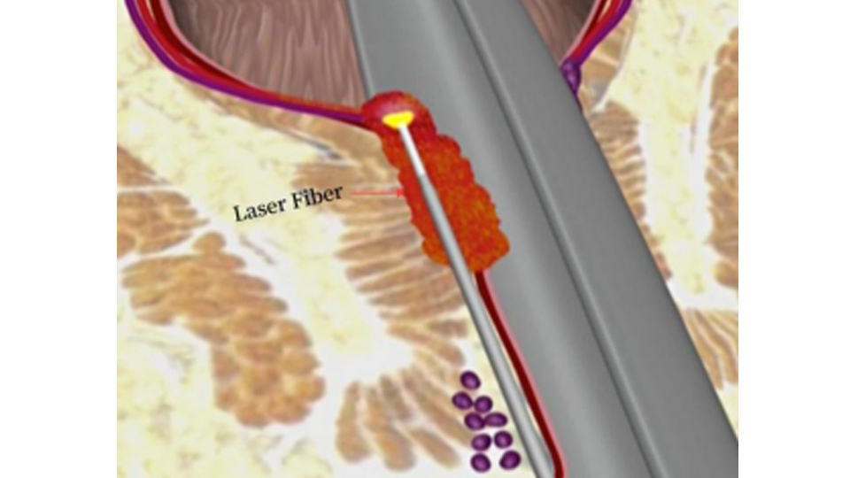 Advantages of Laser Hemorrhoid Surgery